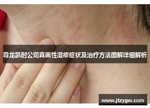 尊龙凯时公司真菌性湿疹症状及治疗方法图解详细解析